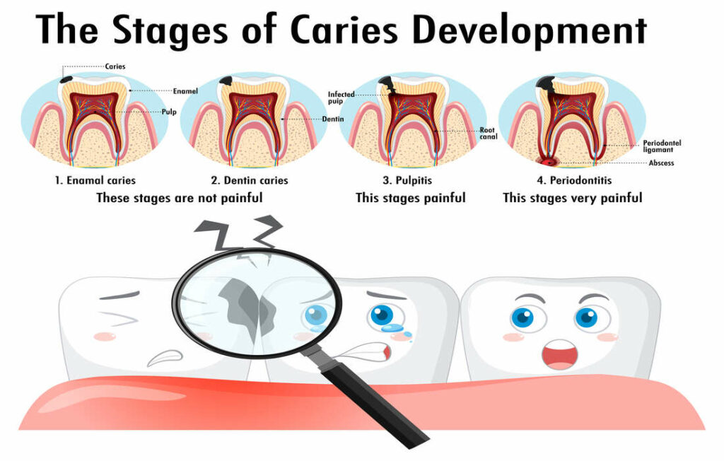 comment évolue une carie dentaire