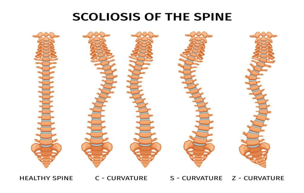 Types de Scoliose