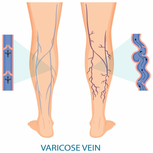 varices