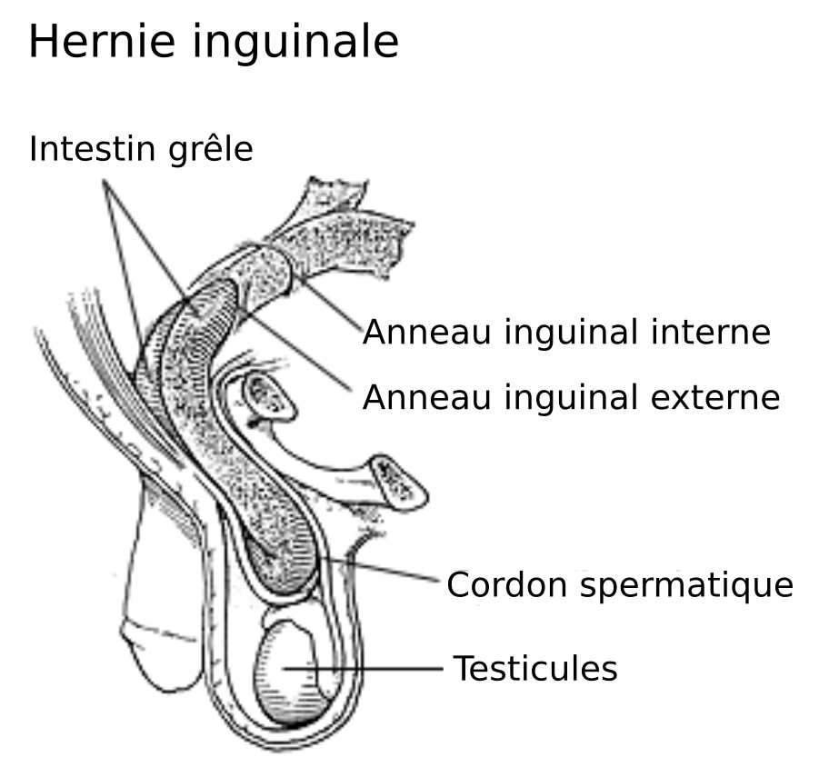 Anatomie de la hernie inguinale