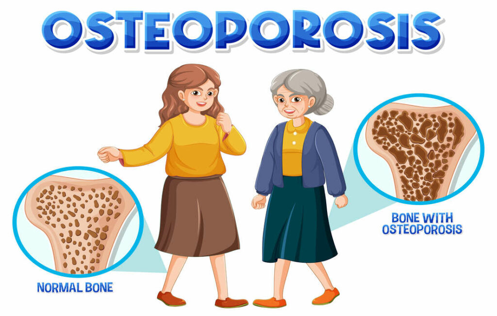 l'Ostéoporose